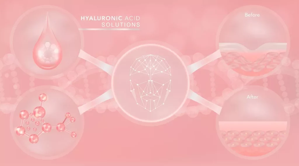 Hyaluronic Dermal Fillers