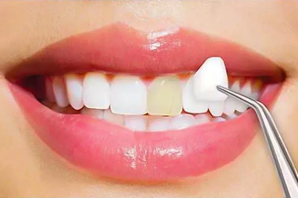 6 Differences Between Lumineers And Veneers - Which Better?